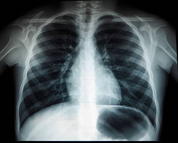 16-летний подросток с туберкулезом: врачи о его спасении